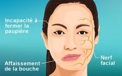 Paralysie faciale : explications et solutions par la kinésithérapie.