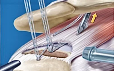 Suture de la coiffe des rotateurs : Protocole de rééducation