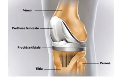 Prothèse totale de genoux : Protocole de rééducation