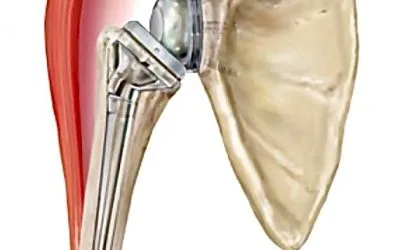 Prothèse totale d’épaule inversée : Protocole de rééducation